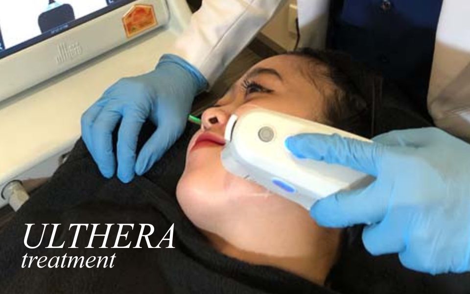 Natasha ULTHERA Treatment
